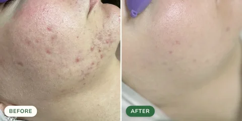 4-Month Ayurvedic Acne Program