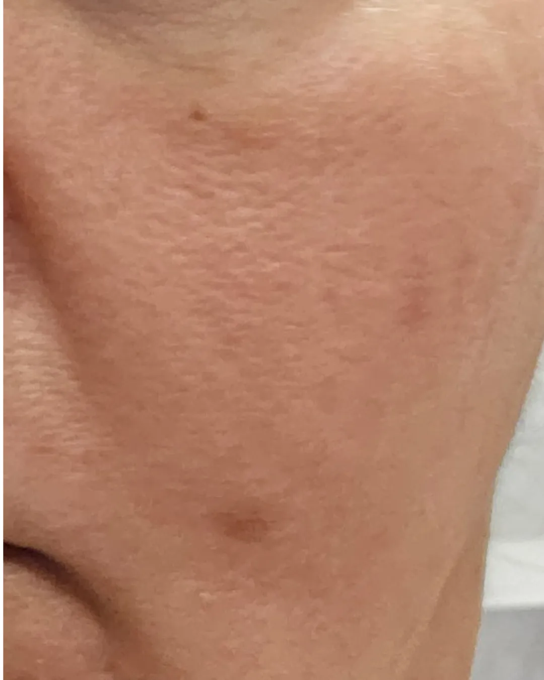Clear skin after Ayurvedic rosacea treatment