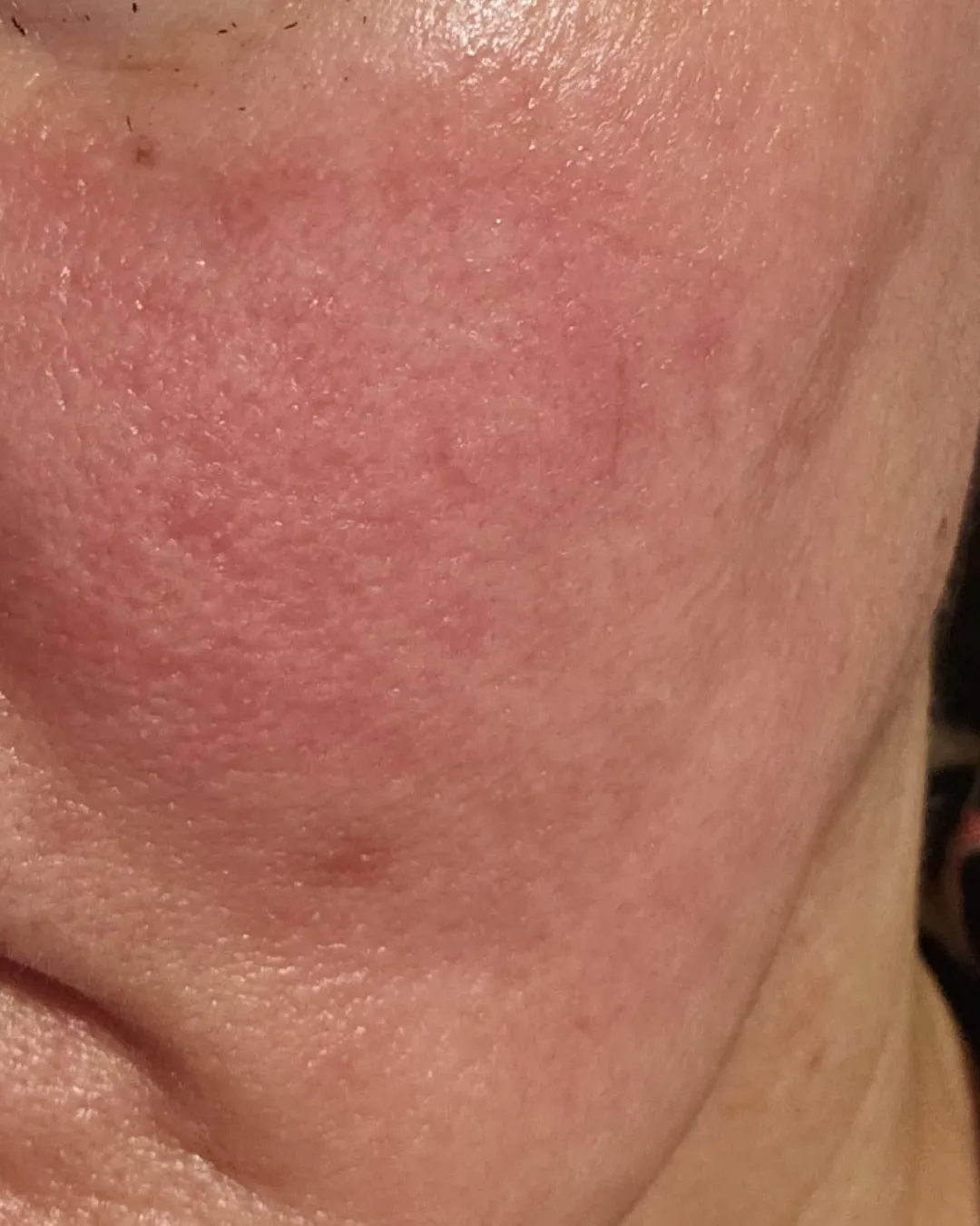 Rosacea and facial redness before Ayurvedic treatment